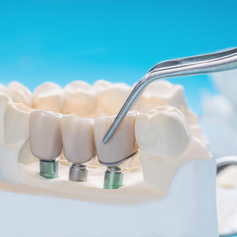 Implantologia Dentalis